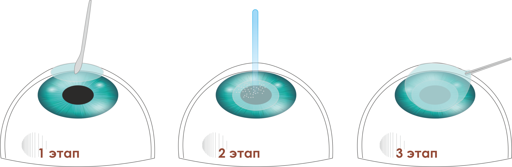 Фрк коррекция зрения. Фоторефракционная кератэктомия. Коррекция ФРК. Этапы ФЕМТОЛАСИК.