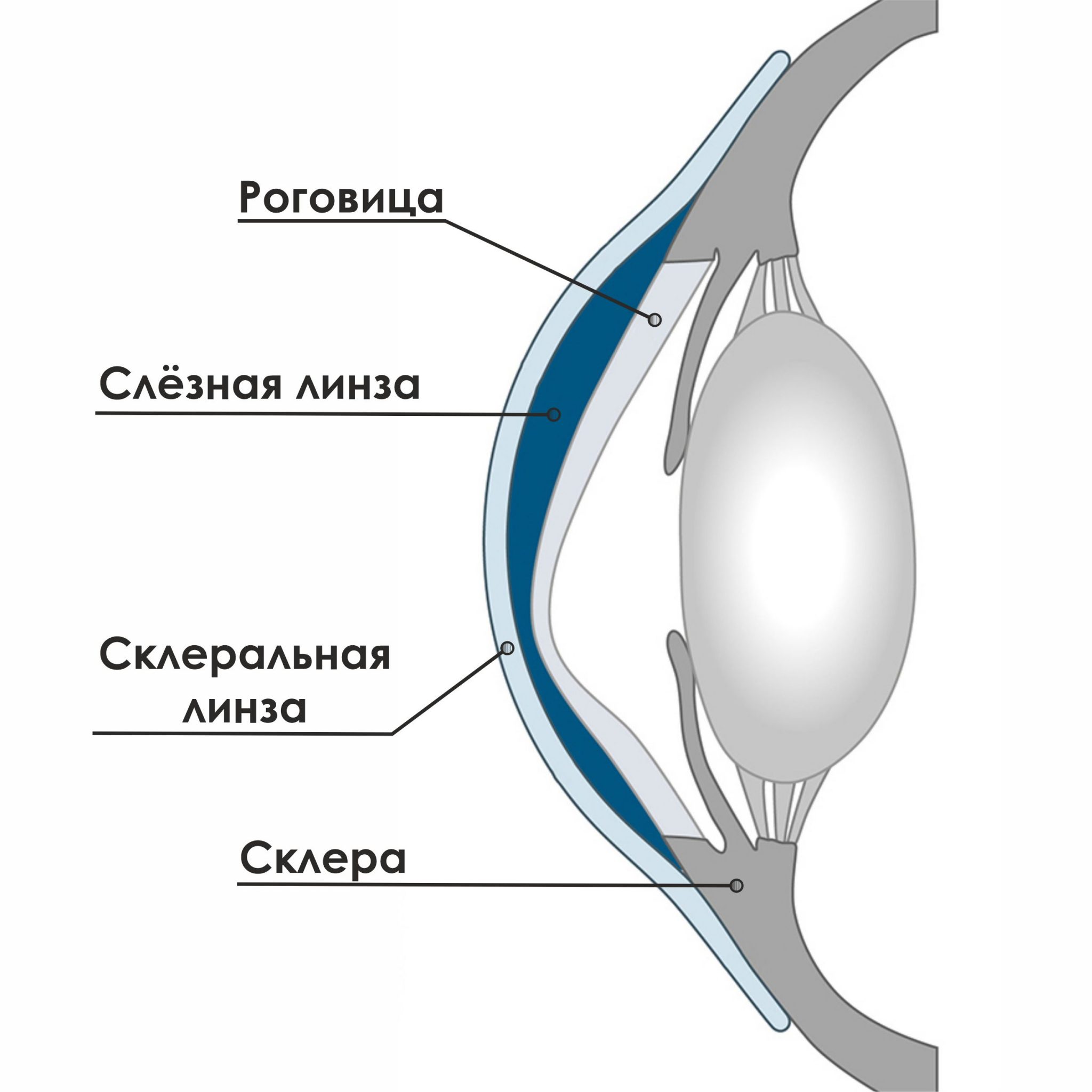 Линза это. Склеральные линзы. Склеральные жесткие линзы. Склеральные линзы при кератоконусе. Жесткие контактные линзы при кератоконусе.