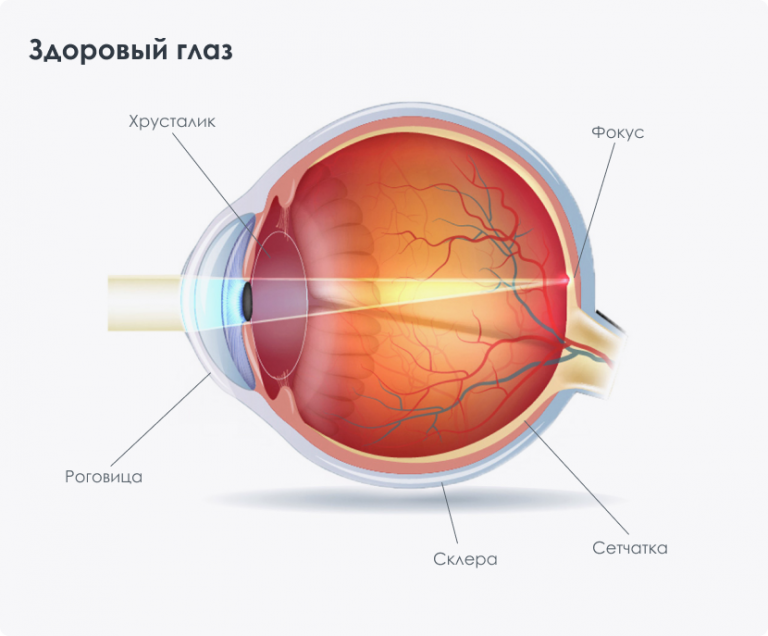 Астигматизм можно вылечить операцией. Роговичный астигматизм. Астигматизм роговицы глаза. Что такое астигматизм зрения. Коррекция астигматизма.