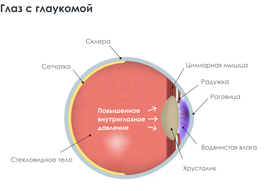 Лазерная трабекулопластика глаза при глаукоме